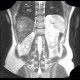 Focal nodular hyperplasia, liver, T2W: MRI - Magnetic Resonance Imaging